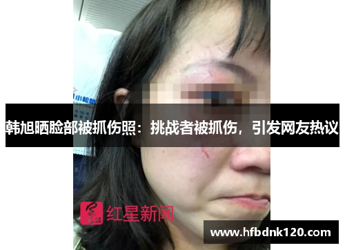 韩旭晒脸部被抓伤照：挑战者被抓伤，引发网友热议